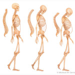 Wirbelsaeulenveraenderungen bei Osteoporose Wirbelsaeulenveraenderungen bei Osteoporose