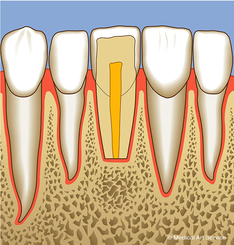 Zahnreihe, Wurzelspitzenresektion